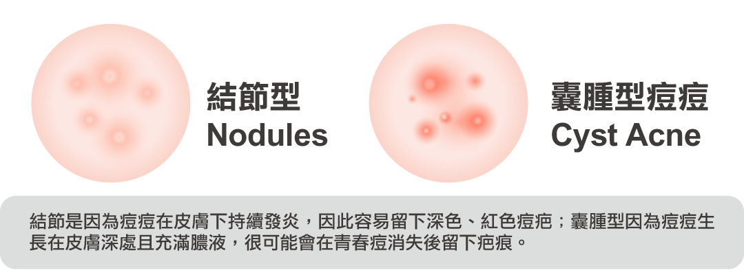 結節型+囊腫型痤瘡