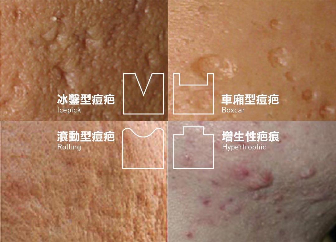痘疤型態分類(增生性疤痕/滾動型痘疤/車廂型痘疤/冰鑿型痘疤/) 痘疤型態分類(增生性疤痕/滾動型痘疤/車廂型痘疤/冰鑿型痘疤/)