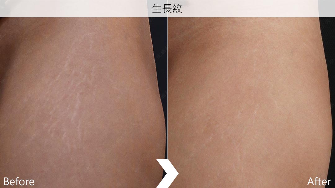 超脈衝生長紋治療術前/術後