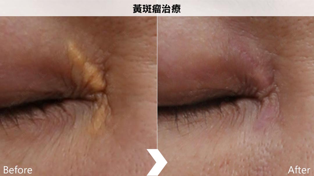 汽化飛梭雷射改善黃斑瘤治療術前/術後-01