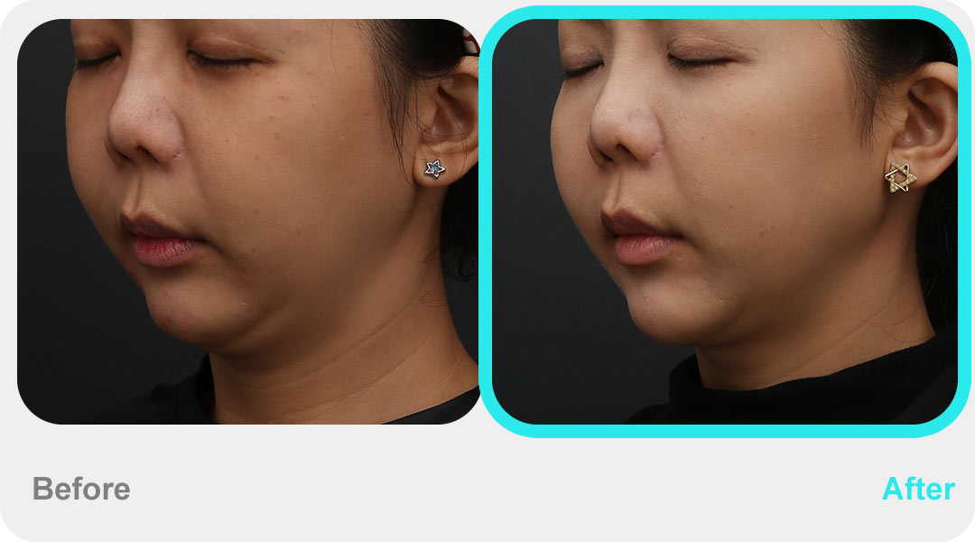 Inmode LIFT 鑽石超塑雙下巴治療效果案例03