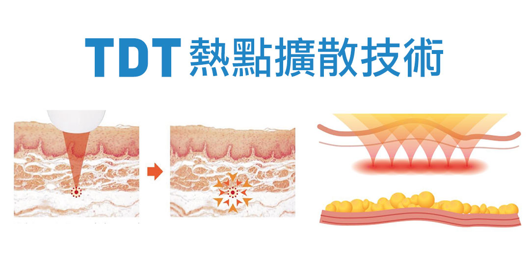 渦漩音波TDT熱點擴散技術 渦漩音波TDT熱點擴散技術