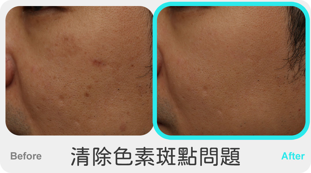 三倍光治療案例-02-清除色素斑點問題
