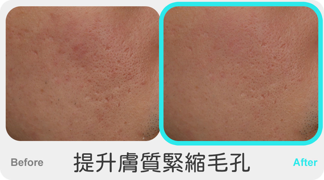 三倍光治療案例-03-提升膚質緊縮毛孔