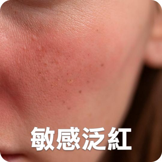 三倍光治療前困擾-敏感泛紅
