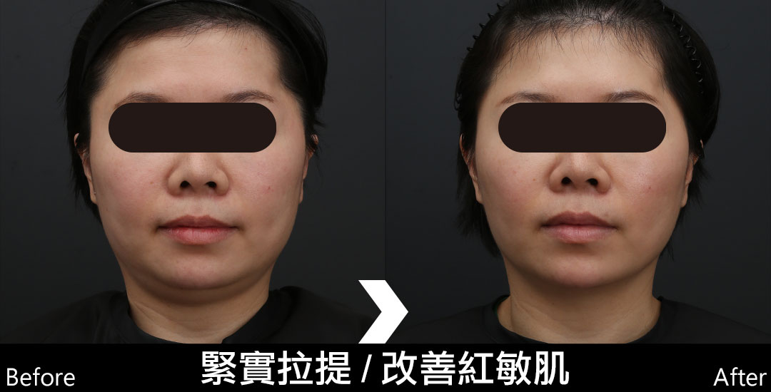 墨菲斯術前術後照-01