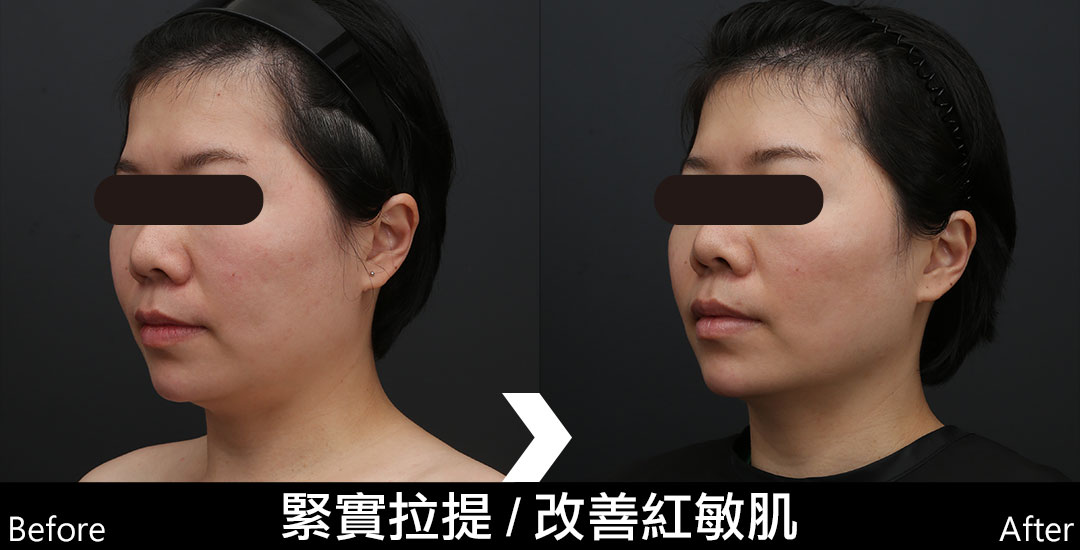 墨菲斯術前術後照-01