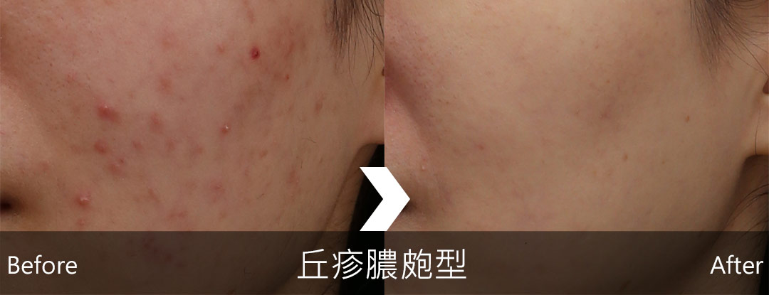 丘疹膿皰型酒糟治療後狀況明顯改善-05