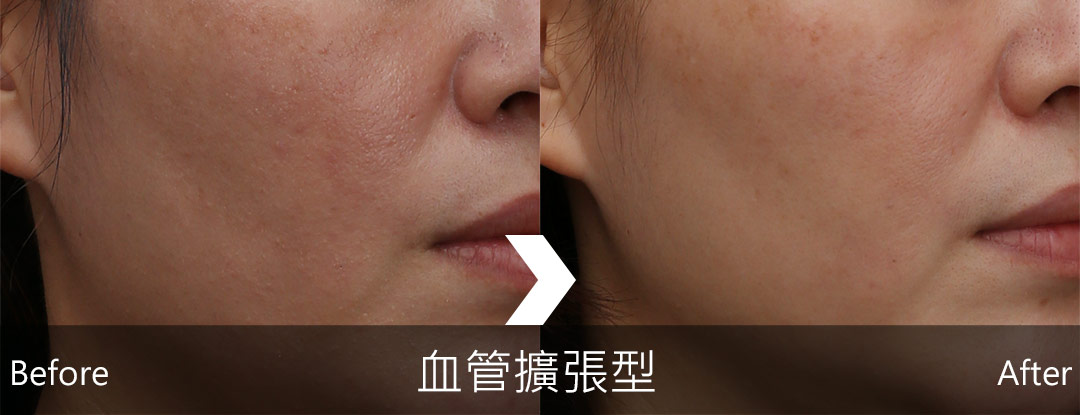 酒糟治療後狀況明顯改善-06
