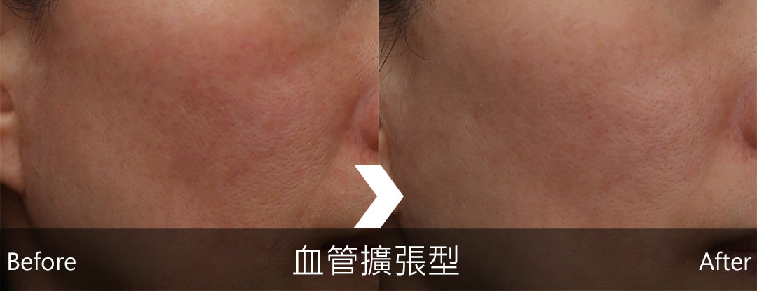 血管擴張型酒糟治療後狀況明顯改善-08