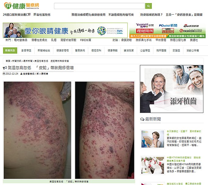 氣溫忽高忽低「皮蛇」帶狀皰疹倍增